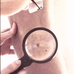 Facts About Melanoma