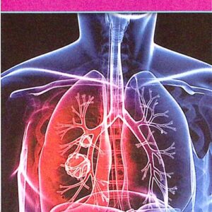 What You Should Know About Lung Cancer